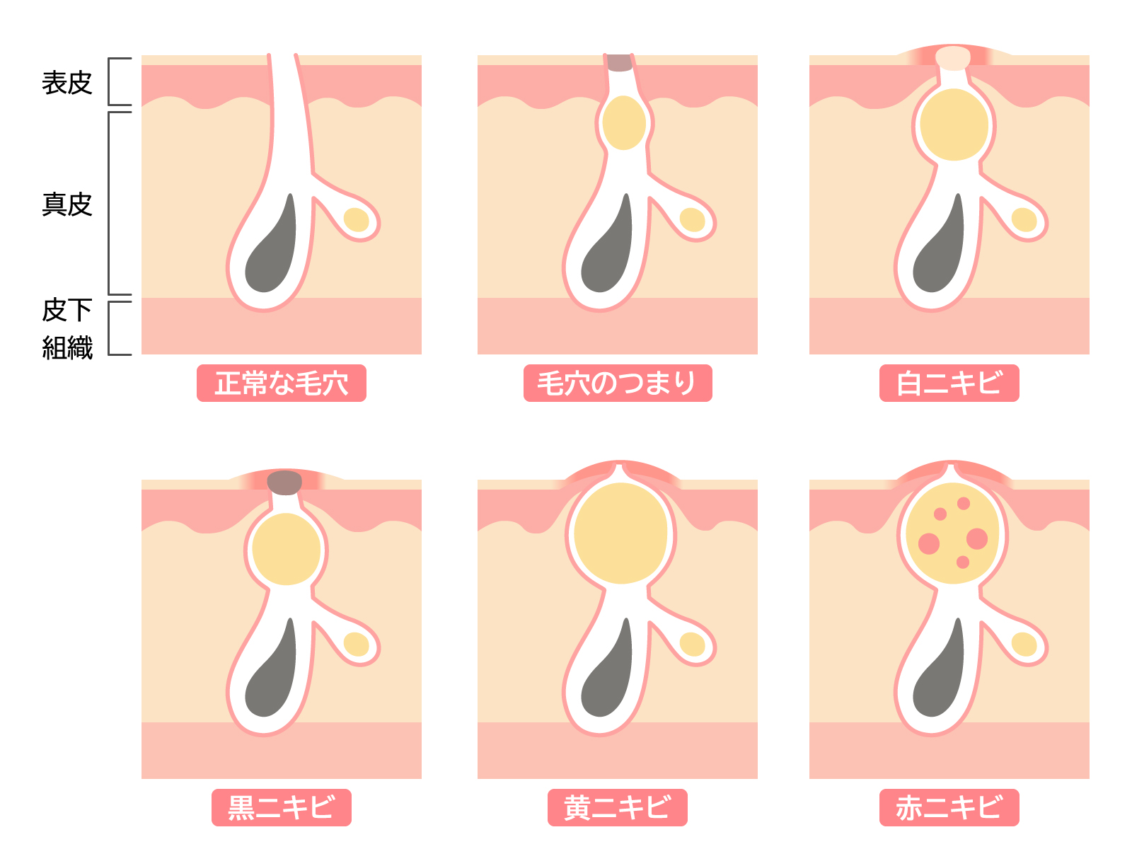 ニキビの進行段階を示す図