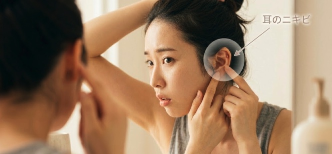 耳のニキビ
