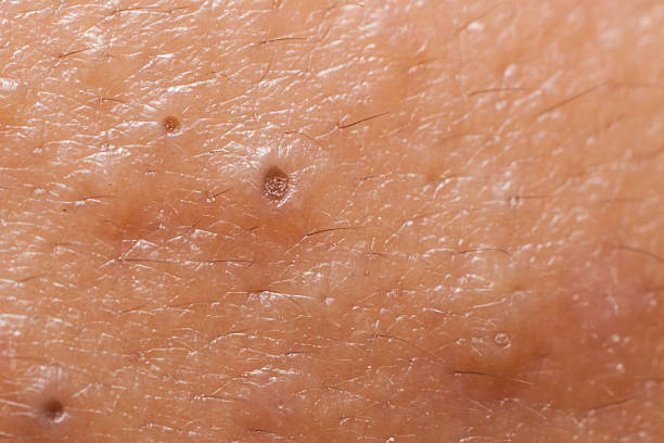 クレータータイプ