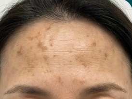 メラニン生成メカニズムの図解