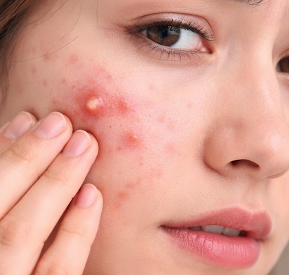 大人ニキビと思春期ニキビの違いとは？原因・発生場所・正しいケアを解説
