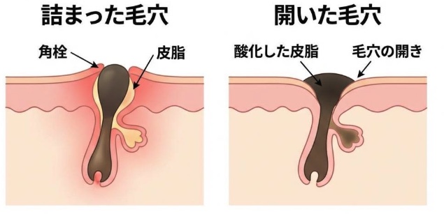 詰まった毛穴と開いた毛穴の断面イラスト