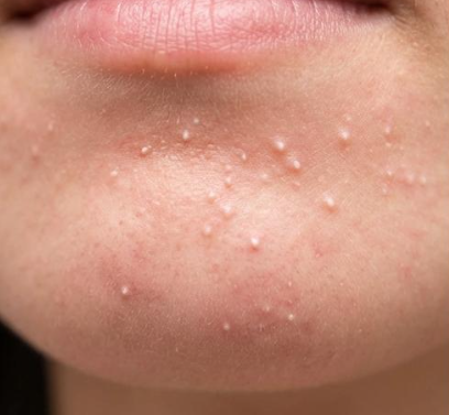 パージと悪化の比較イラスト