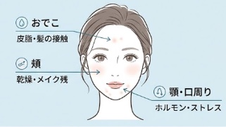 ニキビのできる場所と原因のイラスト