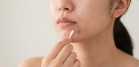 ニキビに触れたり綿棒でケアする女性