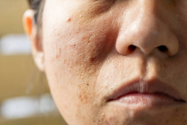 クレーター肌の違いを見極める！自力でケアできる限界と、賢いスキンケア成分の選び方