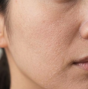 女性の乾燥肌の特徴とケア方法