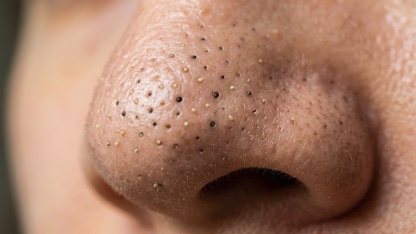 毛穴の黒ずみをなくす方法