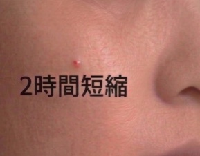 睡眠時間2時間短縮時の肌の様子