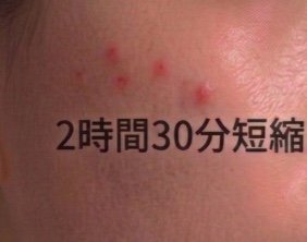 睡眠時間2時間30分短縮時の肌の様子