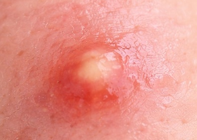 白ニキビのアップ