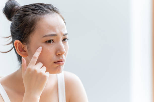 頬の肌トラブルを指さして気にする女性